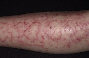 Photographie de la peau d'un patient souffrant du syndrome d'Ekbom