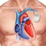 L'histoire du stimulateur cardiaque, plus connu sous le nom de pacemaker