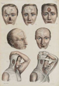 Iconographie d'anatomie chirurgicale et de médecine opérative, Florence, 1841 - Cultea